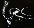 CT angiography showing aneurysm at the ACOM