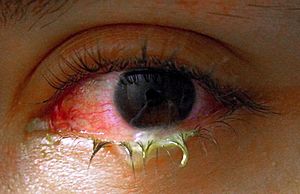Swollen eye with conjunctivitis
