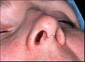 Rhinoplasty Incisions 1
