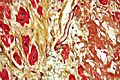 Cardiac amyloidosis very high mag movat