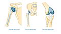 Replacement surgery - Shoulder total hip and total knee replacement -- Smart-Servier (cropped)