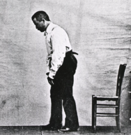 The stooped posture of a patient with Parkinson's