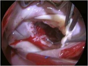 Preop view Mitral valve Dr Sáez de Ibarra