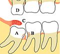 Lower mandibular third molar impaction pericoronitis diagram