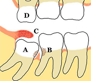 Lower mandibular third molar impaction pericoronitis diagram
