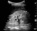 Ultrasonography of kidney with nephrotic syndrome