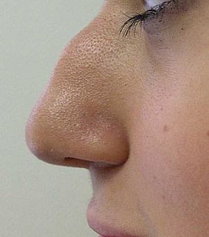 Hump nose2