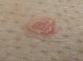 Sebaceaous Hyperplasia Chronic folliculits Right Mid Chest