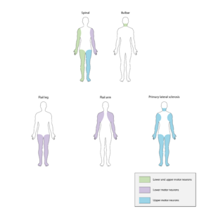 ALS subtypes UMN LMN distribution
