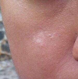 Disappearing sun tan