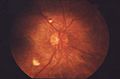 Fundus Proliferative retinopathy EDA01