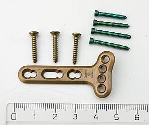 Titanium plaatje voor pols