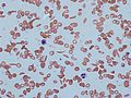 Sickle cells