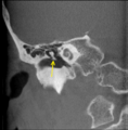 Malleus-Coronal Section of right Tempoporal bone