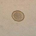 Ascaris lumbricoides4