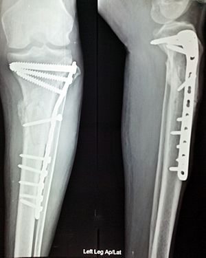 X ray internal fixation leg fracture