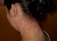 Euproctis Chrysorrhoea skin rash cutted
