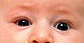 Infant with blepharitis on the right side