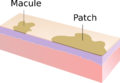 Macule and Patch