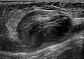Ultrasonography of a thrombosed great saphenous vein aneurysm