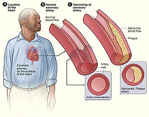 Atherosclerosis 2011
