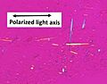 Birefringence microscopy of gout, annotated
