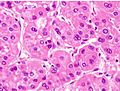 Histopathology of moderately differentiated hepatocellular carcinoma