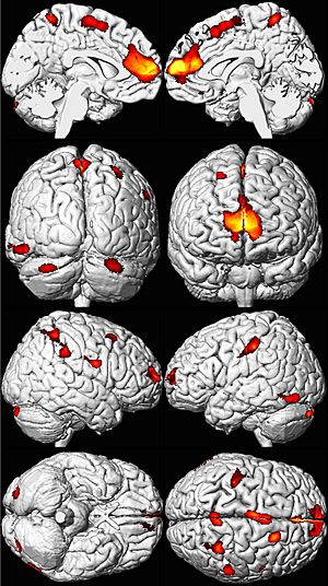 Decreased Brain Volume from Lead Exposure