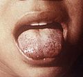 Scorbutic tongue (cropped)