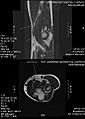 MRI. tear of the distal biceps tendon.