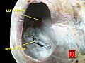 Mitral valve