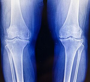 Varus Knee Osteoarthritis Xray