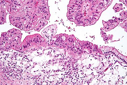 Mucinous lmp ovarian tumour intermed mag.jpg