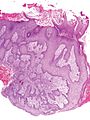 Histopathology of pseudoepitheliomatous hyperplasia, low magnification