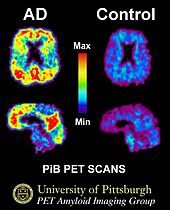 PiB PET Images AD