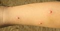 Bem chickenpox vannkopper 20140318