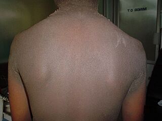 Familial acanthosis nigricans2.jpg