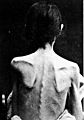 Louis Bataille, 'Deux cas d'anorexie hysterique' Wellcome L0020548 (backcropped)