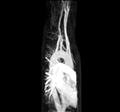 Arteria-lusoria MRA MIP