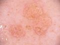 Dermoscopy of sebaceous hyperplasia