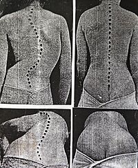 Collage of the Abbott's method results of the bloodless scoliosis treatment