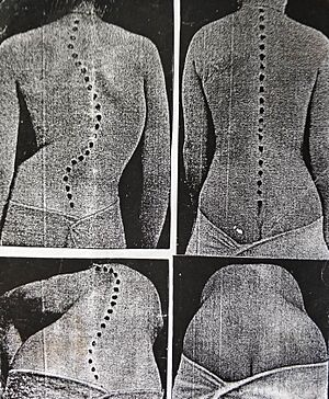 Collage of the Abbott's method results of the bloodless scoliosis treatment