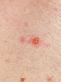 Chickenpox blister