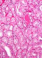 Chromophobe renal cell carcinoma, eosinophilic variant - high mag