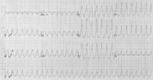 Electrocardiogram of Ventricular Tachycardia