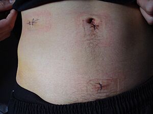 Stitches post appendicitis surgery