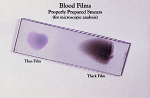 Blood film 01