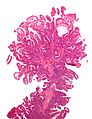 Peutz-Jeghers syndrome polyp
