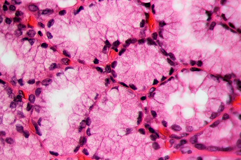 Chronic recurrent cholecystitis, HE 5