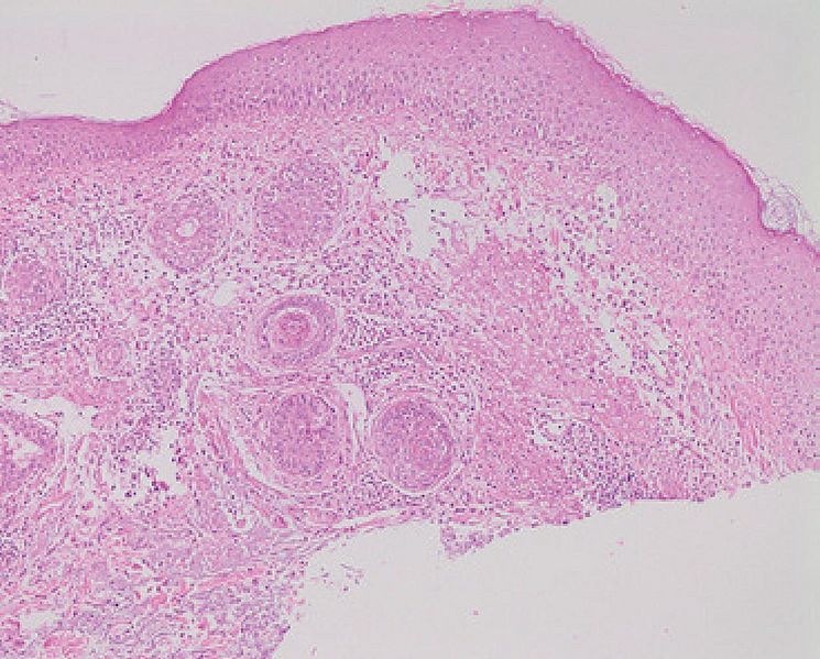 Micrograph of rosacea
